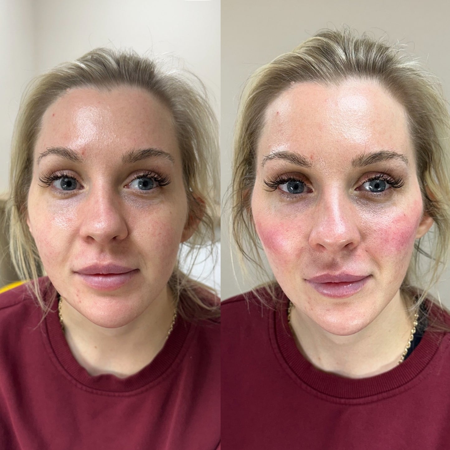 Advanced Dermal fIller (Aesthetics Training)