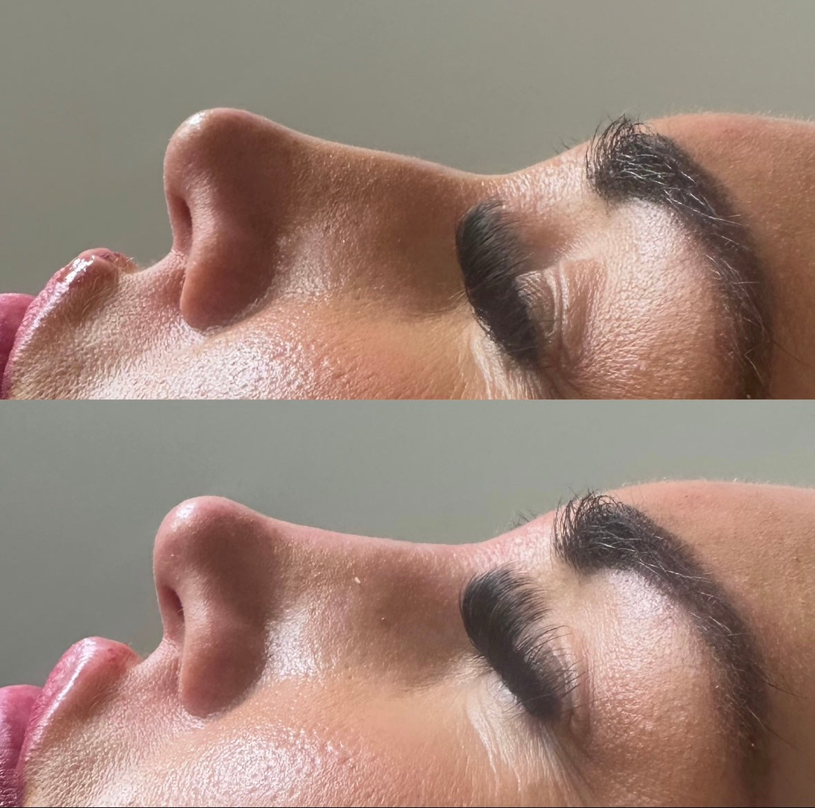 The Non Surgical Nose Mastery Experience (Advanced Filler Training)