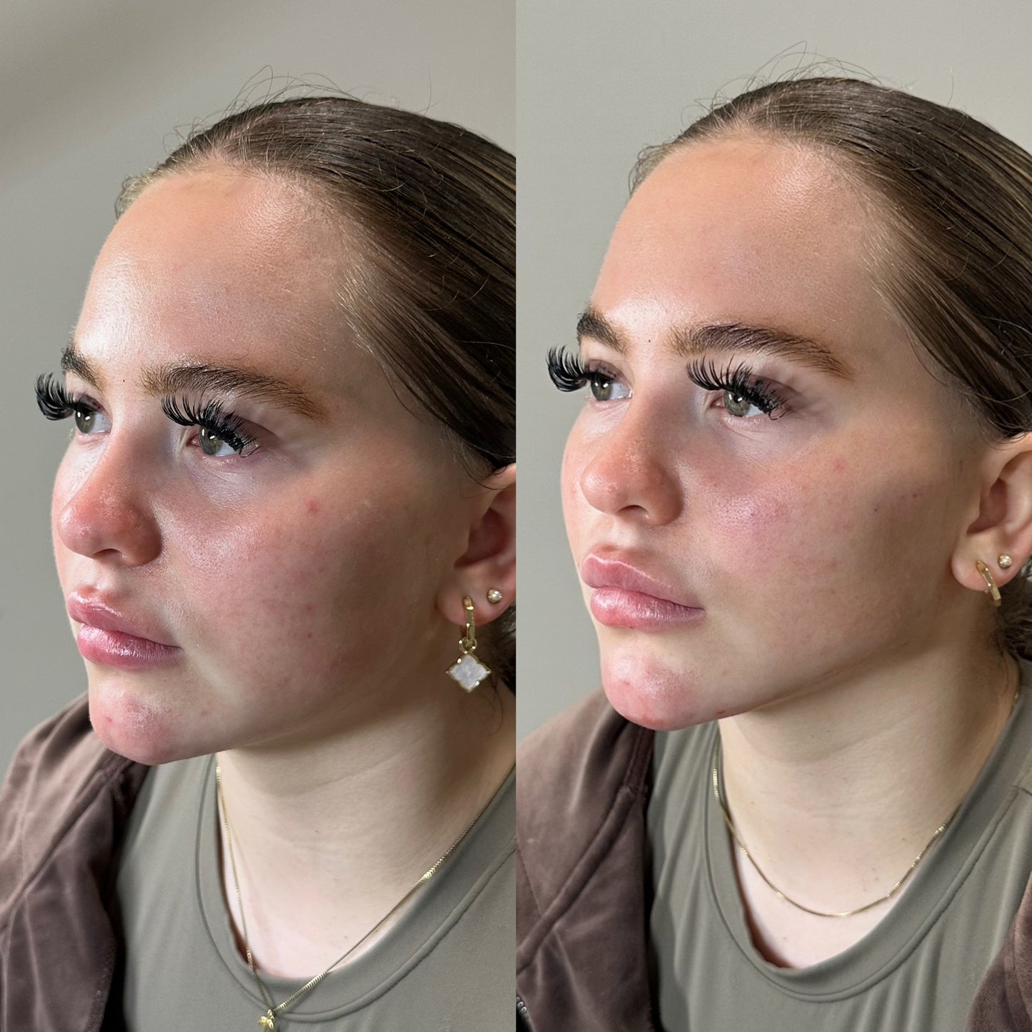 Advanced Dermal fIller (Aesthetics Training)