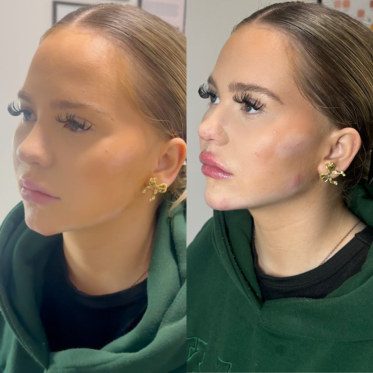 Liquid Facelift