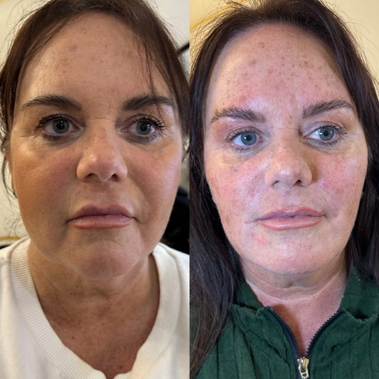Liquid Facelift