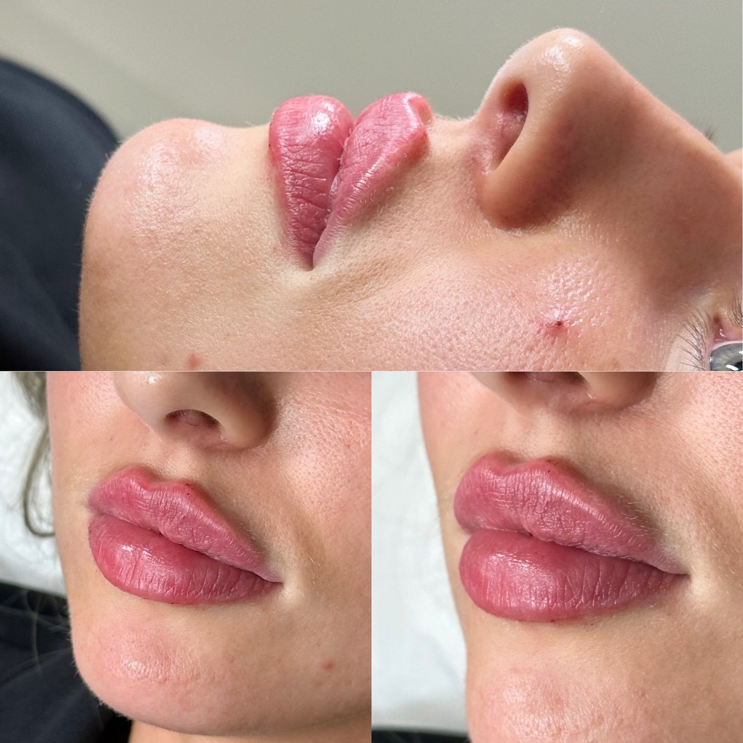 Advanced Dermal fIller (Aesthetics Training)
