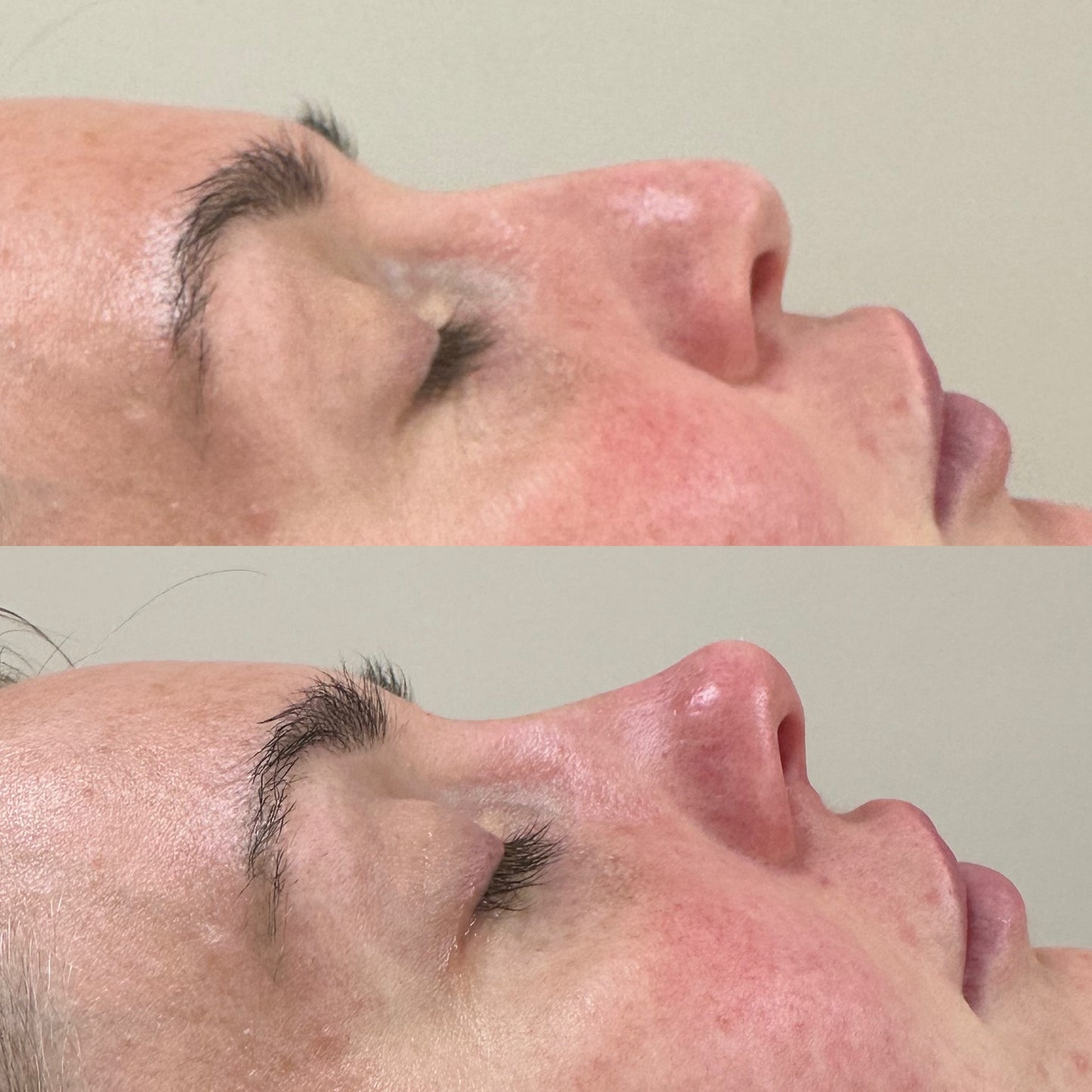 Advanced Dermal fIller (Aesthetics Training)