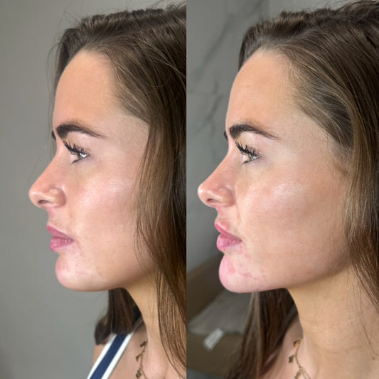 Advanced Dermal fIller (Aesthetics Training)