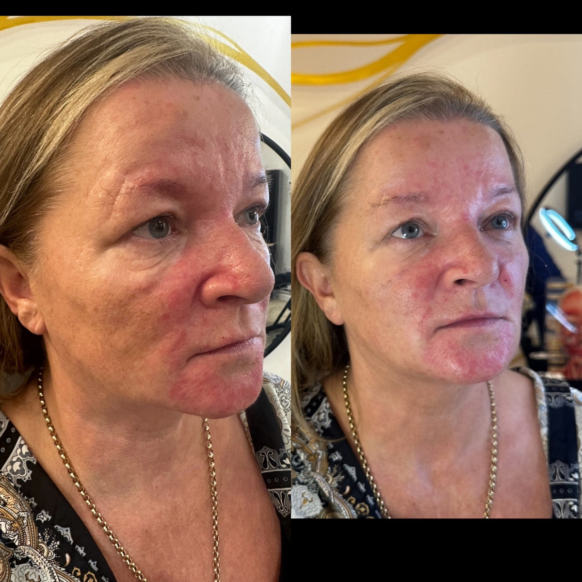 Liquid Facelift