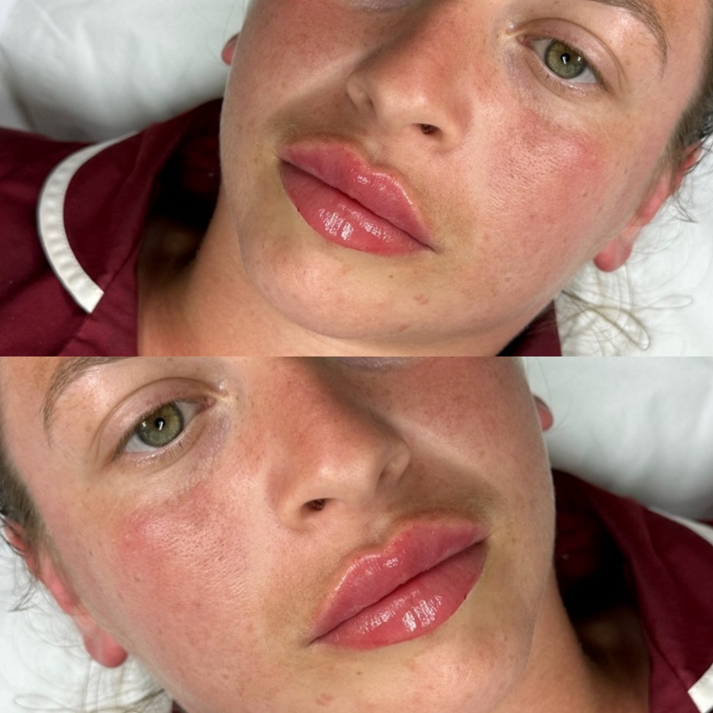 Advanced Dermal fIller (Aesthetics Training)