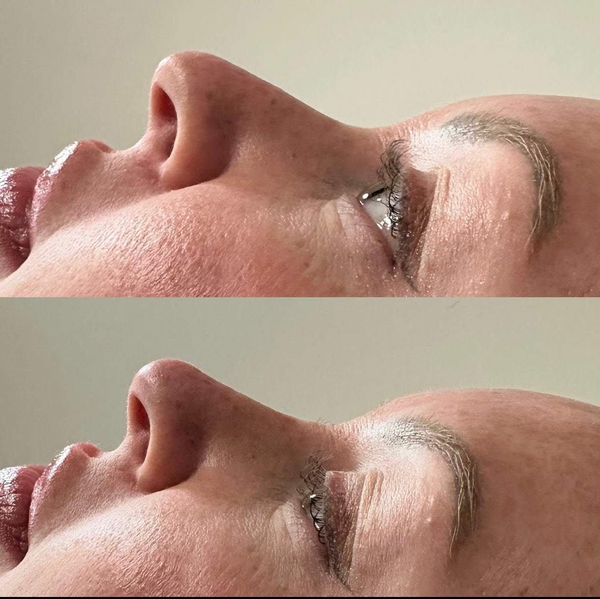 The Non Surgical Nose Mastery Experience (Advanced Filler Training)