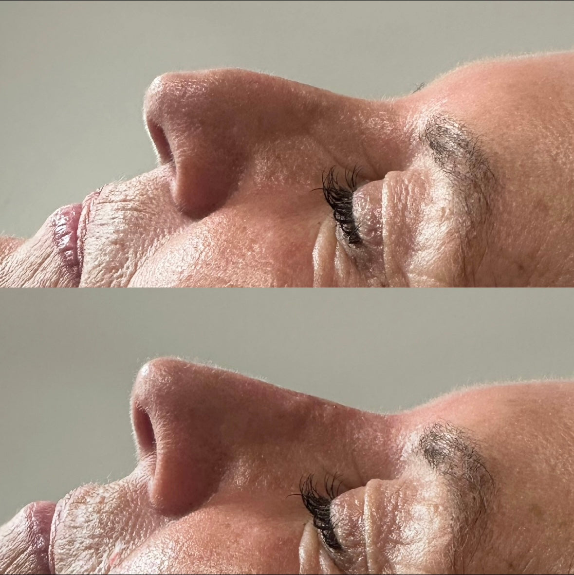 The Non Surgical Nose Mastery Experience (Advanced Filler Training)