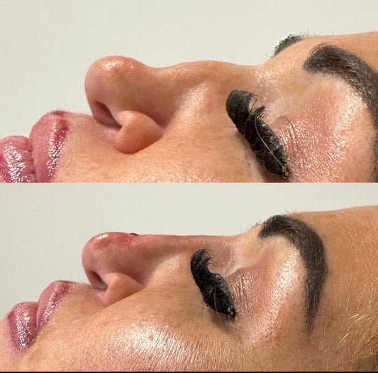 The Non Surgical Nose Mastery Experience (Advanced Filler Training)