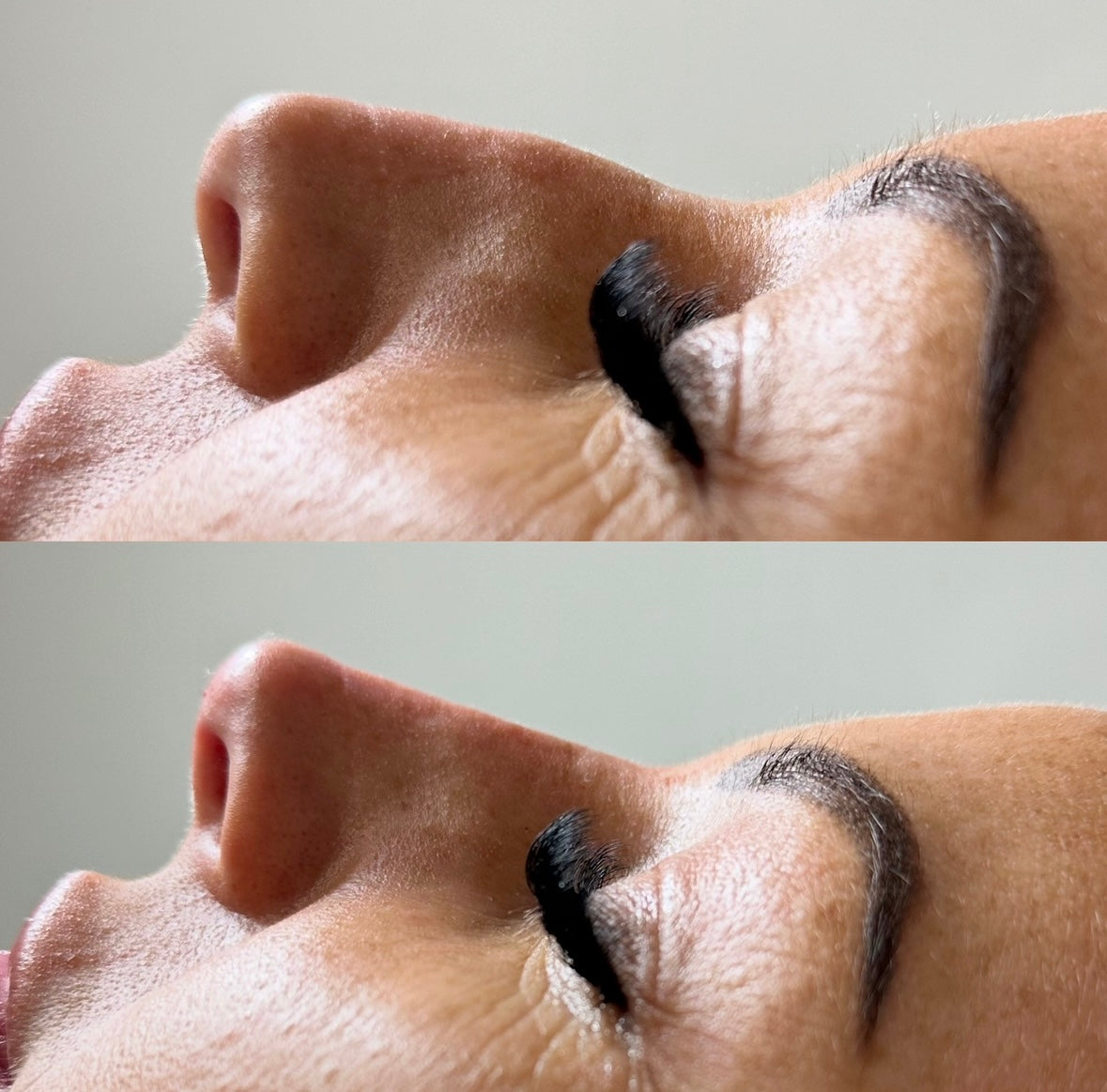 The Non Surgical Nose Mastery Experience (Advanced Filler Training)