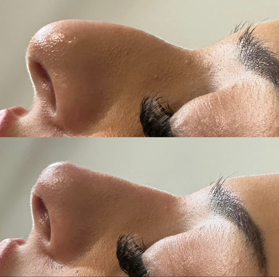 The Non Surgical Nose Mastery Experience (Advanced Filler Training)