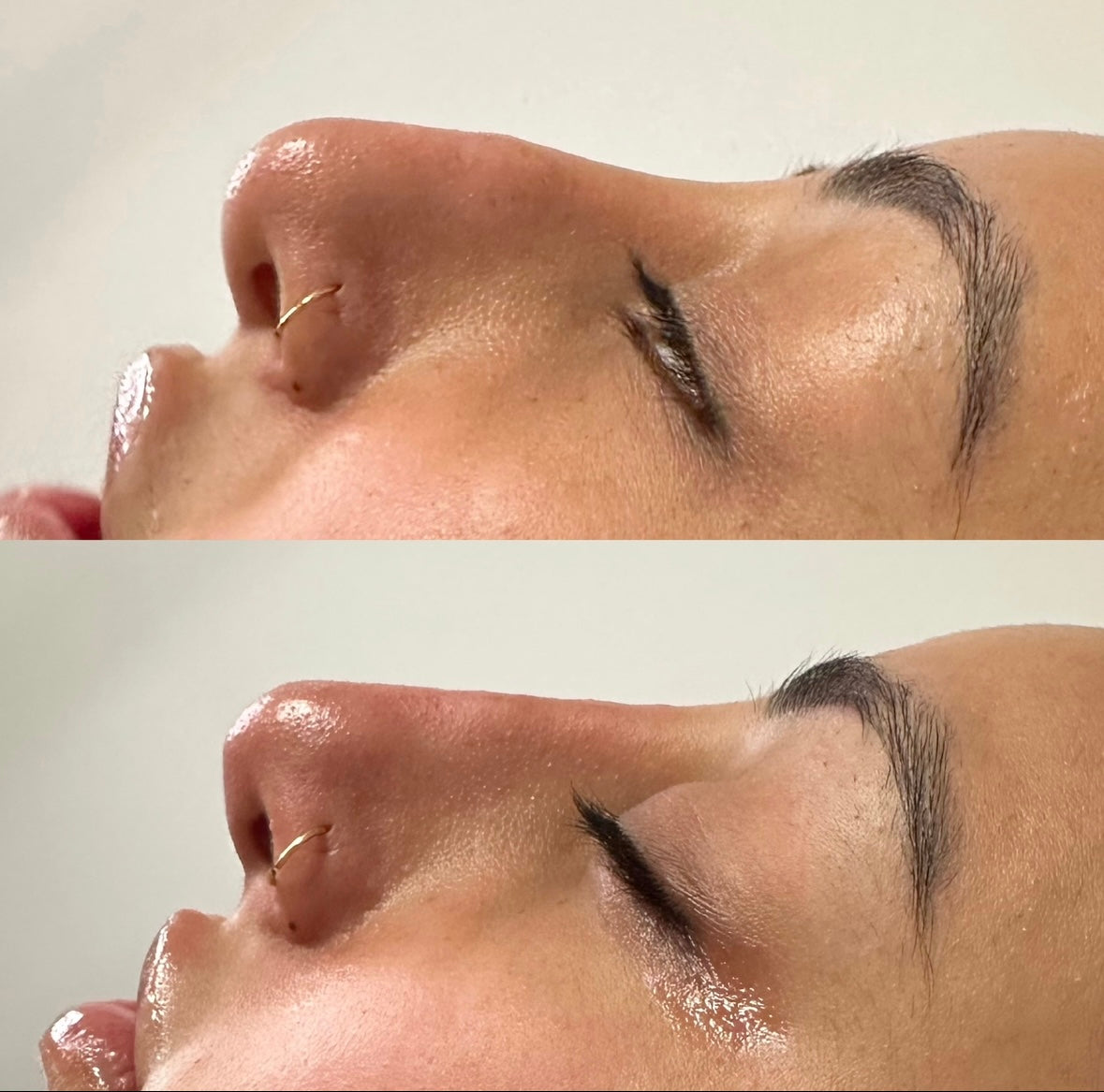 The Non Surgical Nose Mastery Experience (Advanced Filler Training)