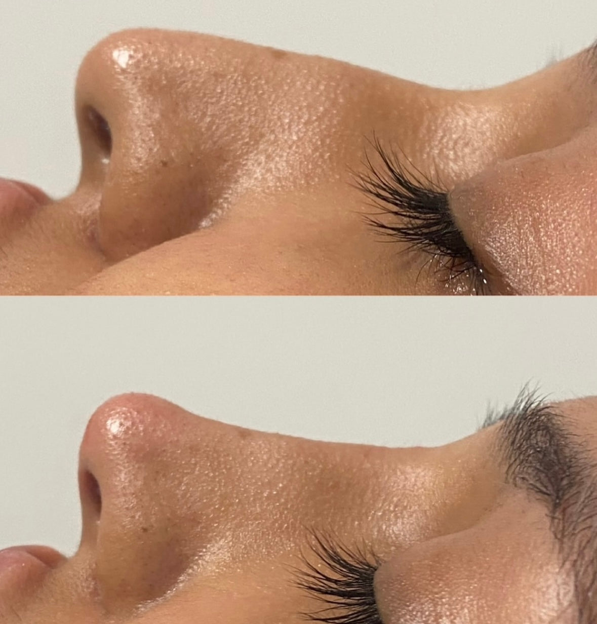 The Non Surgical Nose Mastery Experience (Advanced Filler Training)