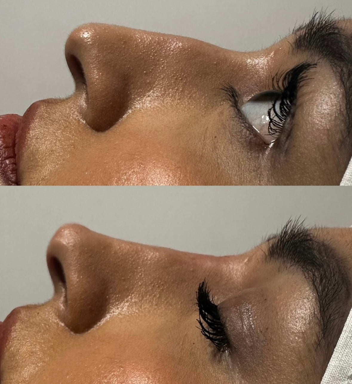 The Non Surgical Nose Mastery Experience (Advanced Filler Training)