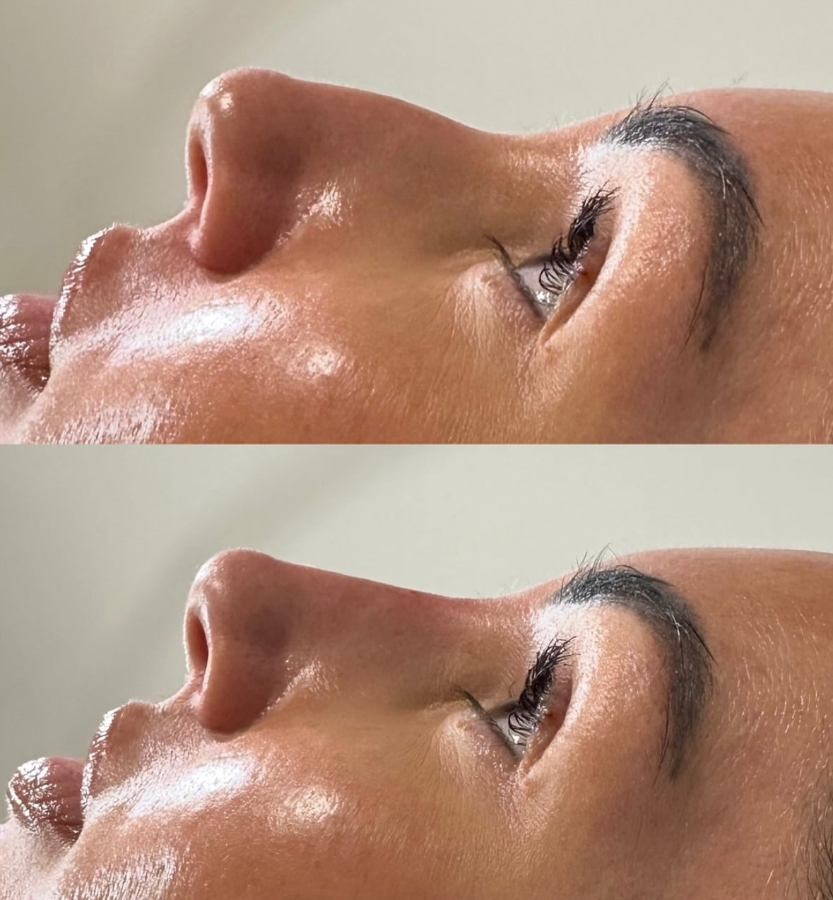 The Non Surgical Nose Mastery Experience (Advanced Filler Training)