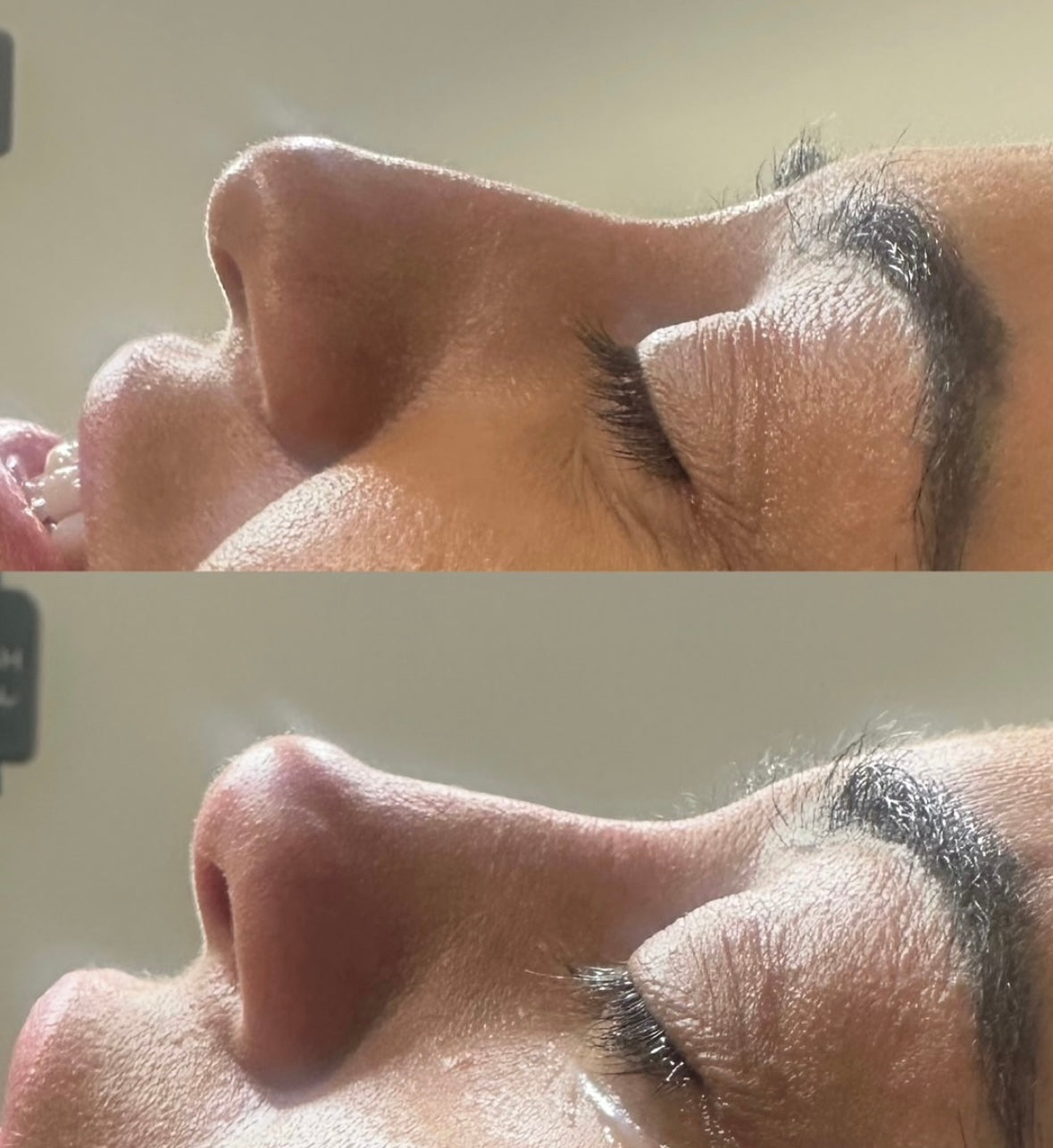 The Non Surgical Nose Mastery Experience (Advanced Filler Training)
