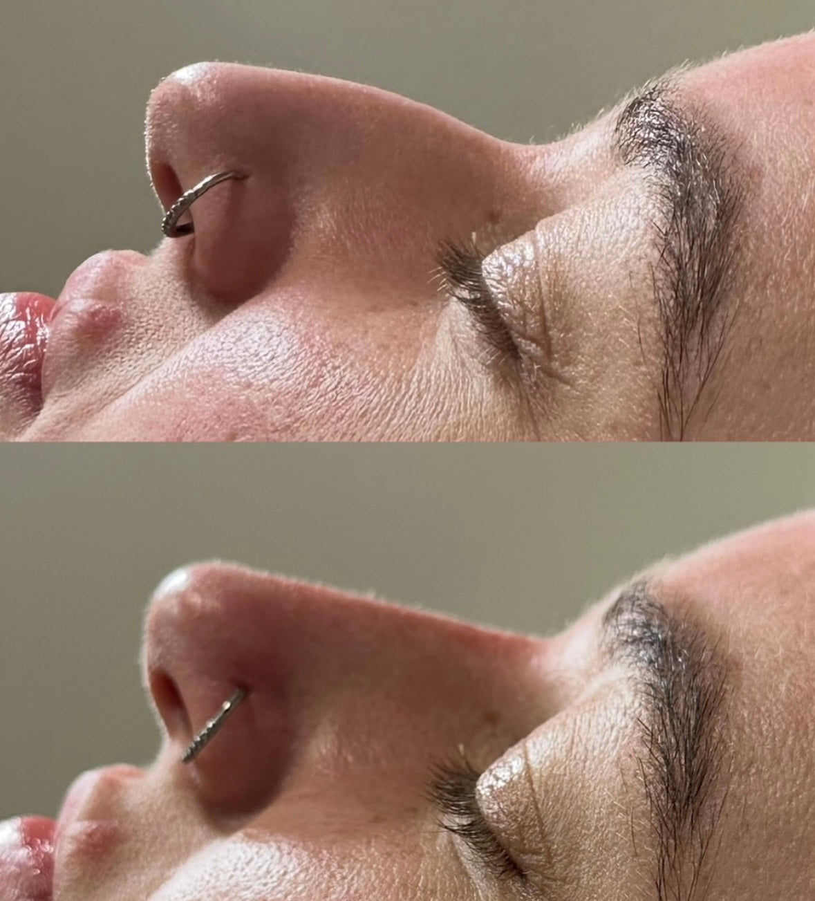 The Non Surgical Nose Mastery Experience (Advanced Filler Training)