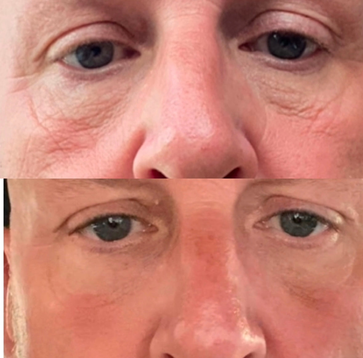 The Tear Trough, Temple & Mid Face Lift Masterclass (Practical)