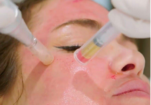 Microneedling Training Course (Practical)